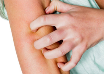 ​Trajtimi i zgjebes, dermatologia Kokollari: Pacientët reagojnë keq dhe ndihen të stigmatizuar