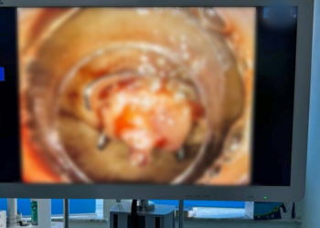 ShSKUK: Për herë të dytë u krye ndërprerja e gjakderdhjes masive nga stomaku me metodat e reja