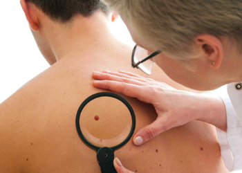 Nishanet ose njollat e zeza që shfaqen në lëkurë kanë përmasa dhe forma të ndryshme