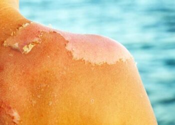 Si të parandalojmë rrjepjen e lëkurës pas djegies nga dielli