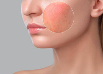 Mënyrat natyrale për trajtimin e mykut në lëkurë