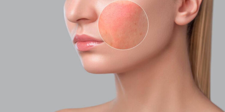 Mënyrat natyrale për trajtimin e mykut në lëkurë