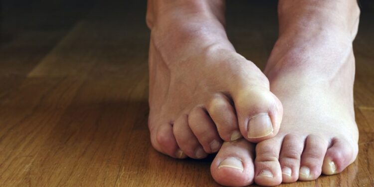 Katër mënyra si të parandaloni djersitjen e këmbëve gjatë verës