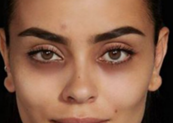 Largoni rrathët e zinj të syve me këto metoda