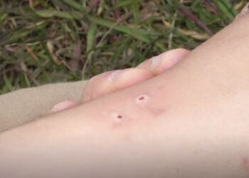 15 raste me kafshim gjarpri për dy muaj, QKMF-të pa doza të serumit