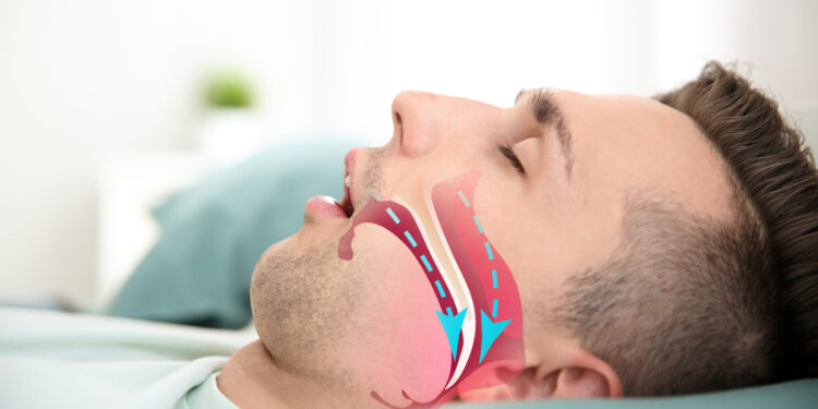 Çfarë është apnea e gjumit dhe cilat janë simptomat?