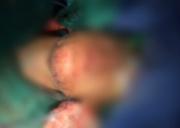 QKUK kryen një operim për herë të parë, zgjati 13 orë