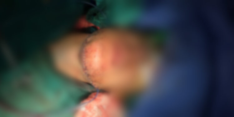 QKUK kryen një operim për herë të parë, zgjati 13 orë