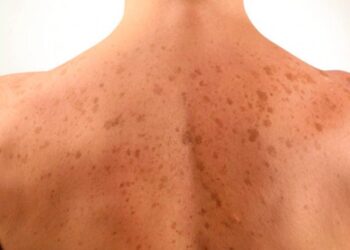 Njollat e errëta në lëkurë – mënyrat natyrale si t’i trajtoni