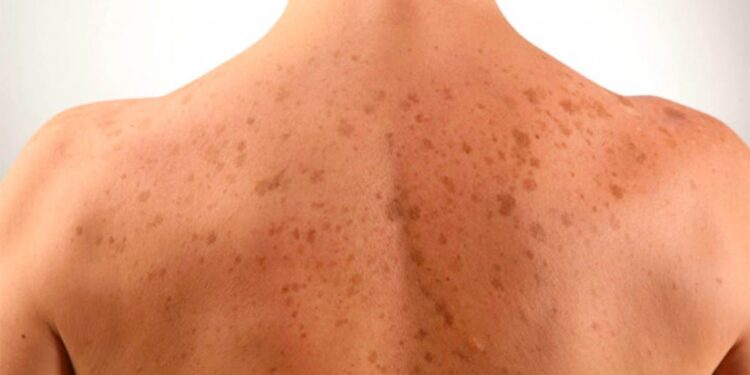 Njollat e errëta në lëkurë – mënyrat natyrale si t’i trajtoni