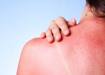 Çfarë nuk duhet të bëni kur digjeni nga dielli – Këshillat nga dermatologët