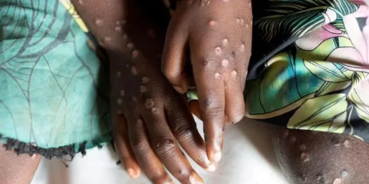 Mpoxi nuk është Covid i ri dhe mund të ndalet, thotë eksperti i OKB-së