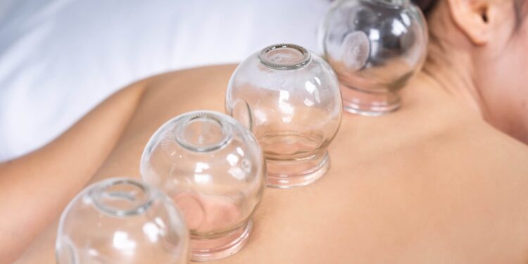 Çfarë është terapia me kupa? Problemet shëndetësore që trajton