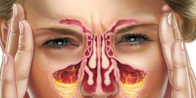 Gjërat që duhet të dini për kujdesin ndaj sinuseve