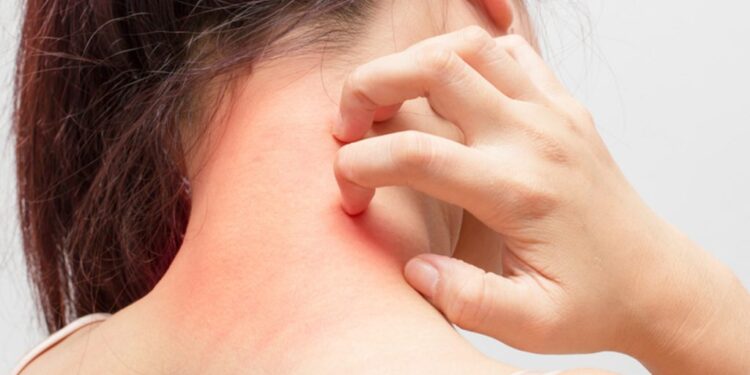 Kruarja e lëkurës – Pse ndodh dhe zgjidhjet natyrale në kushtet e shtëpisë