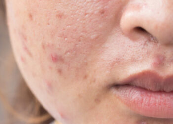 Harta e akneve në fytyrë, mesazhet e fshehura të shëndetit