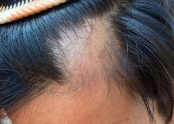 Rënia e flokut, si ta zgjidhni problemin që në rrënjë