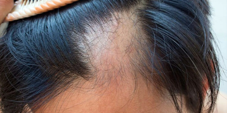 Rënia e flokut, si ta zgjidhni problemin që në rrënjë