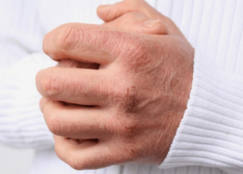 Pse na çahen duart dhe si ta parandalojmë këtë gjatë dimrit