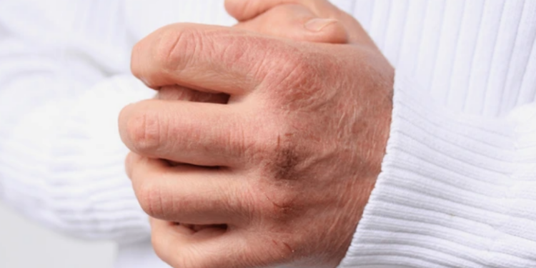 Pse na çahen duart dhe si ta parandalojmë këtë gjatë dimrit