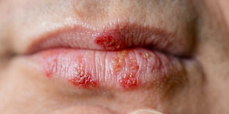 Pse shfaqet herpsesi në buzë? – metodat si ta parandaloni dhe trajtoni