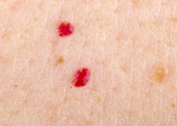Shfaqja e nishaneve të kuq në trup – rastet kur janë shqetësuese