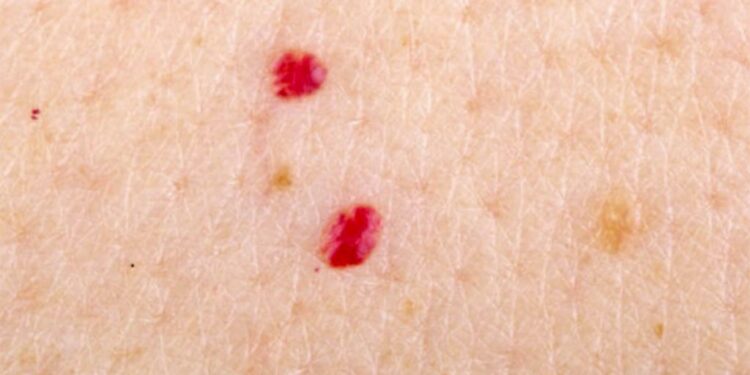 Shfaqja e nishaneve të kuq në trup – rastet kur janë shqetësuese