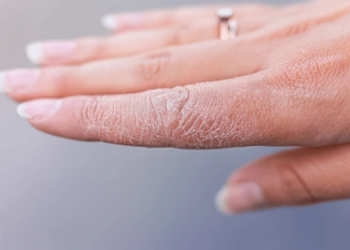 Trajtoni duart e çara me këto metoda