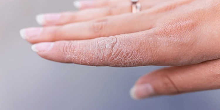 Trajtoni duart e çara me këto metoda