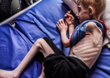 Më shumë se 65,000 fëmijë të hospitalizuar në Gaza për shkak të kequshqyerjes