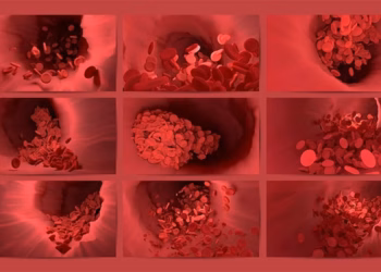 Çfarë është tromboza dhe si mund ta parandalojmë?!