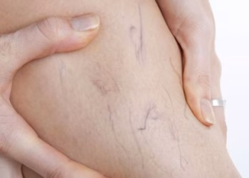 5 mite dhe të vërteta rreth sëmundjeve venoze