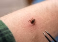 Rriqra nuk transmeton vetëm sëmundjen Lyme: Mund të shkaktojë alergji të rrezikshme ndaj mishit