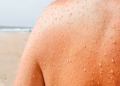 Të kruhet lëkura sapo del nga deti? Dermatologët zbulojnë arsyen