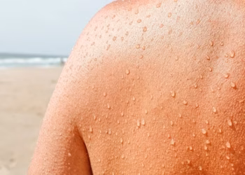 Të kruhet lëkura sapo del nga deti? Dermatologët zbulojnë arsyen